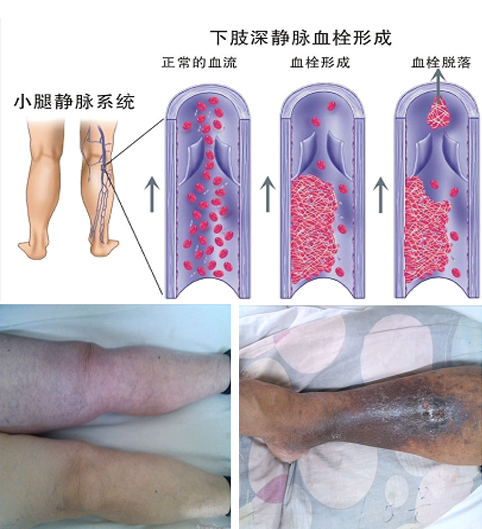 血栓.jpg