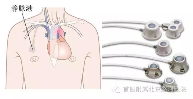 800 我院普外科成功开展首例植入式静脉输液港.jpg