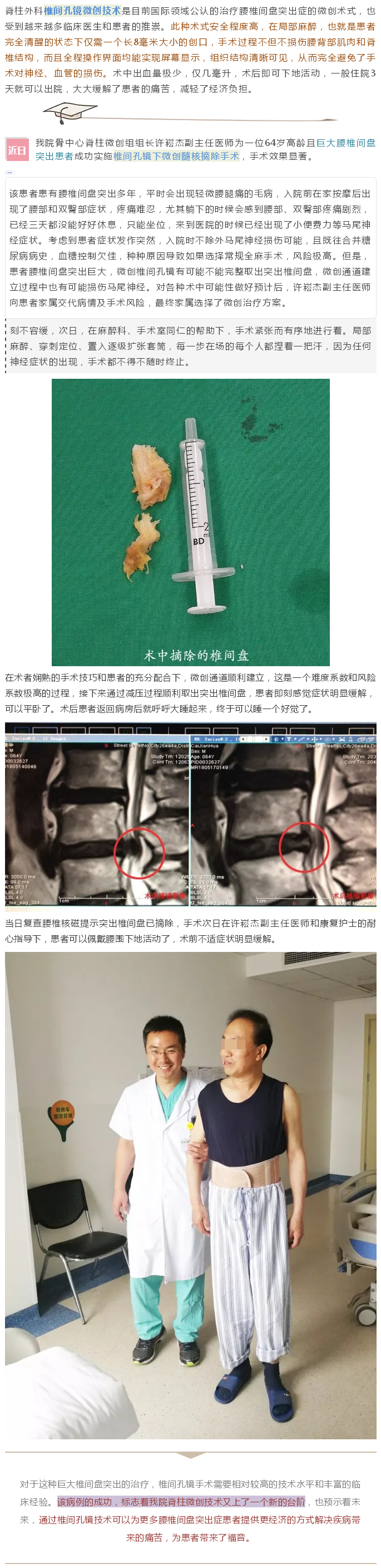 小创口 大文章——潞河医院采用椎间孔镜微创技术治疗巨大腰椎间盘突出症.jpg