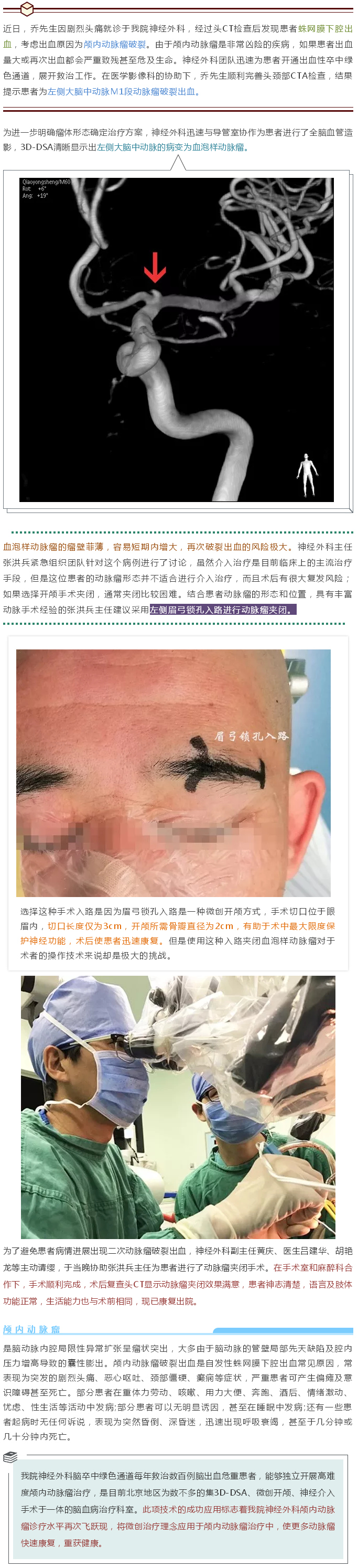 眉弓锁孔入路 成功夹闭血泡样动脉瘤.jpg