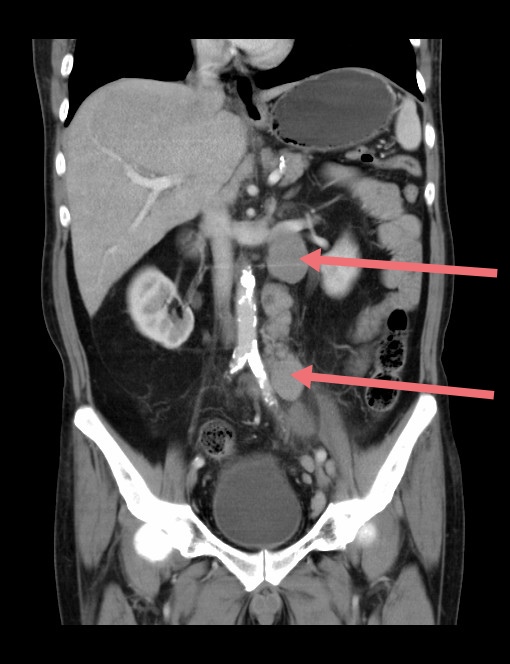 腹腔霍奇金淋巴瘤CT冠状位图像.jpg 腹腔霍奇金淋巴瘤CT冠状位图像.jpg