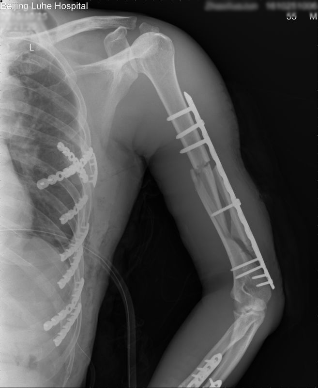 多发肋骨骨折+肱骨骨折同期手术