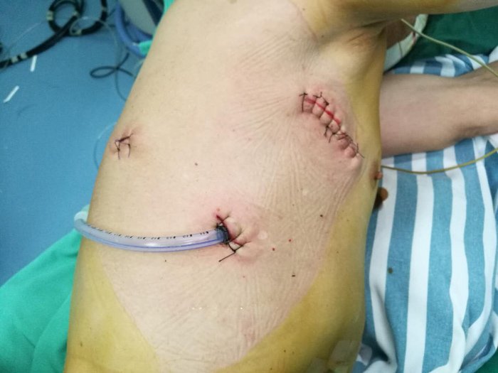 胸腹腔镜食道癌切除手术---2