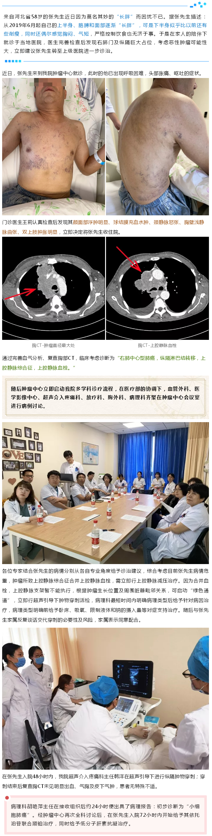 2019-09-24 肿瘤中心 --- “深呼吸 享受清新的氧气”——记潞河医院肿瘤中心成功救治一例“上腔静脉综合征”患者---1.jpg