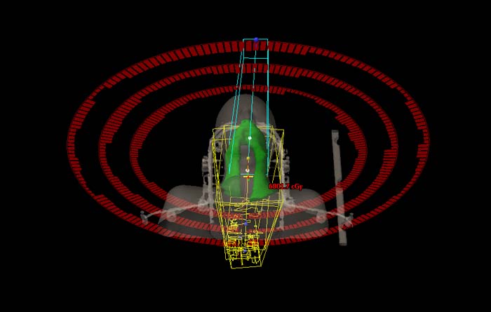 鼻咽癌 放疗计划设计.jpg