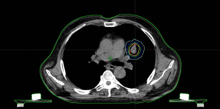 肺癌大分割放疗计划剂量线.jpg
