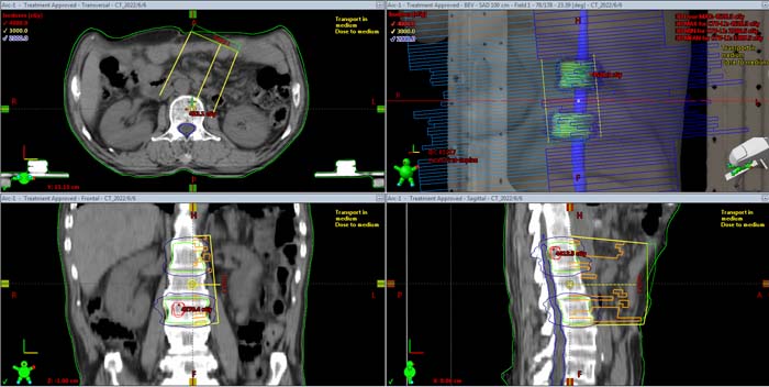 椎体转移放疗计划.jpg