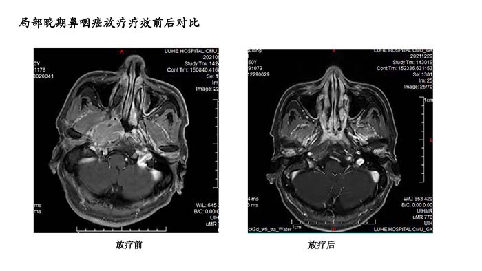 鼻咽癌疗效分享-1.jpg