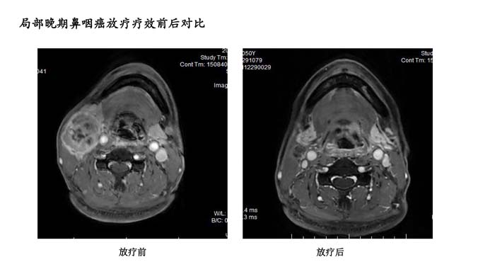 鼻咽癌疗效分享-2.jpg