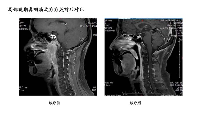 鼻咽癌疗效分享-4.jpg