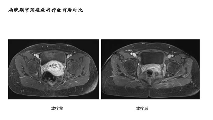 宫颈癌疗效分享-1.jpg