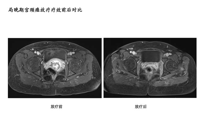 宫颈癌疗效分享-2.jpg