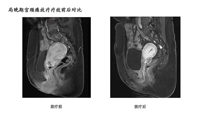 宫颈癌疗效分享-3.jpg