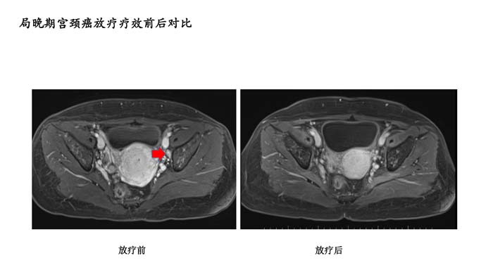 宫颈癌疗效分享-4.jpg