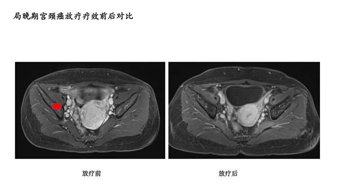 宫颈癌疗效分享-5.jpg