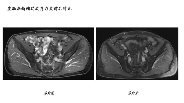 直肠疗效对比-2.jpg