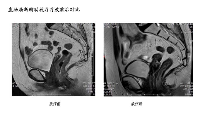 直肠疗效对比-3.jpg