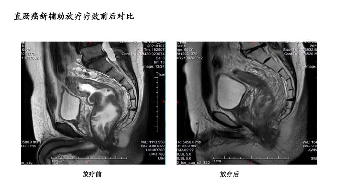 直肠疗效对比-4.jpg